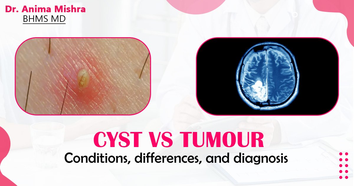 Cyst vs tumour: Conditions, differences, and diagnosis