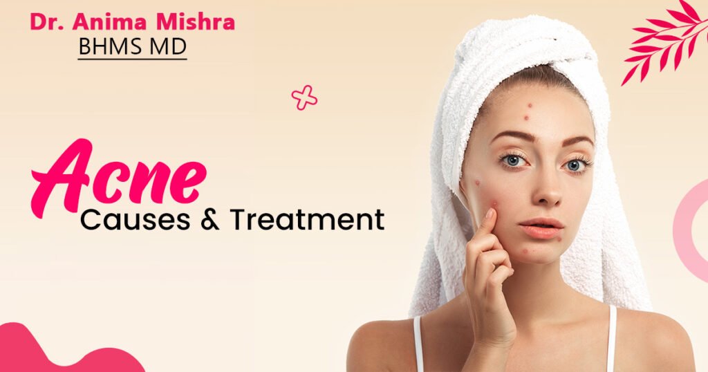 Acne Causes and Treatment