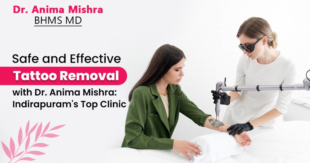 Tattoo Removal in Indirapuram