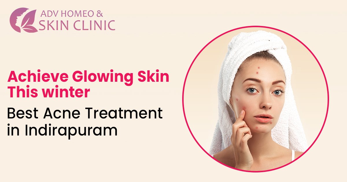 Acne Treatment in Indirapuram: Achieve Glowing Skin